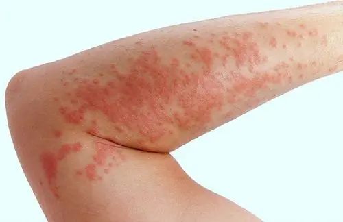 😳 These Small Bumps May Look Harmless, But Experts Say They're Worth Monitoring