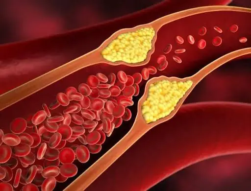 High Blo.od Pressure and High Cholesterol? Avoid These 3 Morning Habits That Could Harm Your Heart