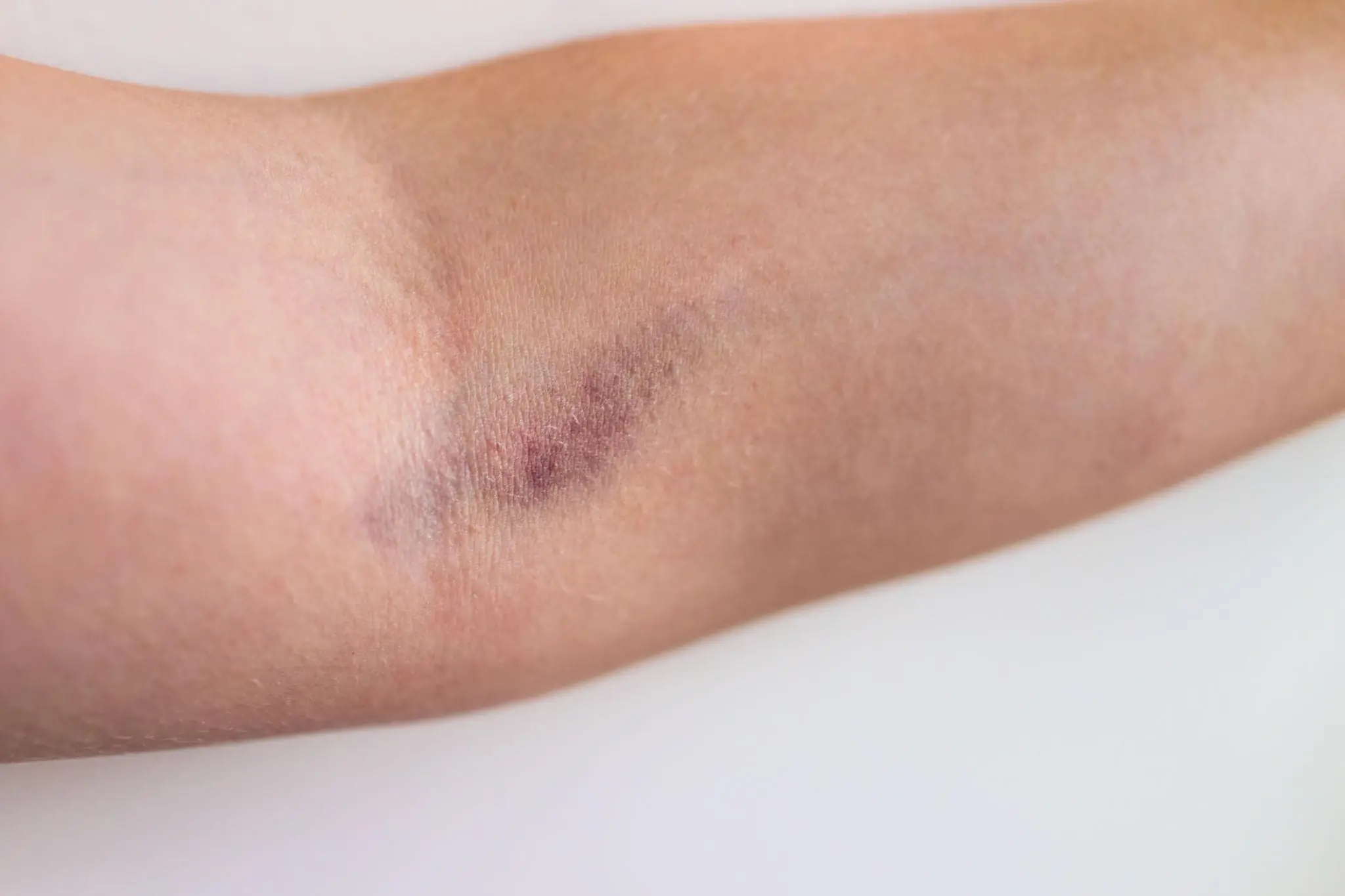 BE CAREFUL, if you get these bruises on your body, it means you have Ca…see more