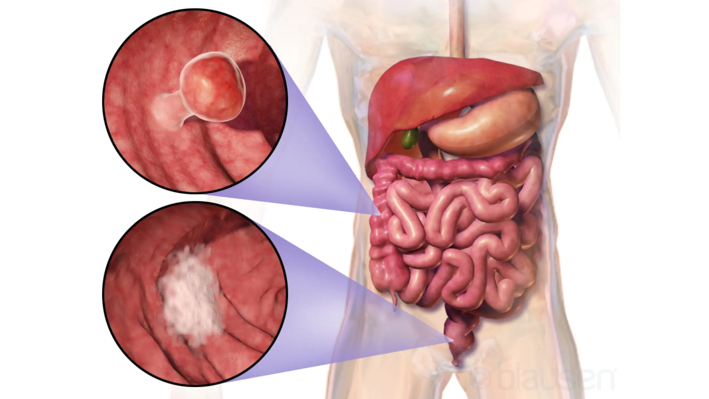 Pancreatic Cancer: Key Symptoms That Deserve Medical Attention