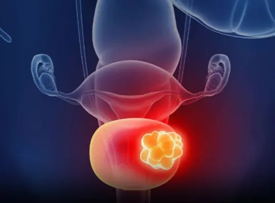 5 Common Warning Signs of Bladder Can:cer You Should Never Ignore