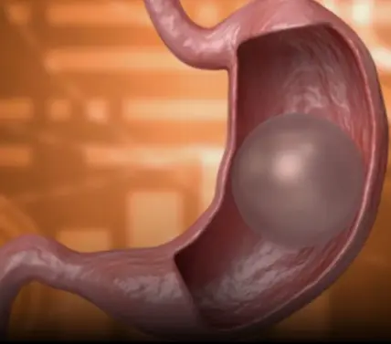 What happens if the gastric balloon bur.sts?