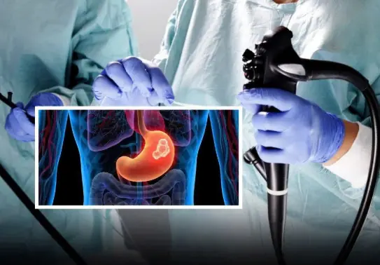 Most cases of stomach can:cer are detected too late