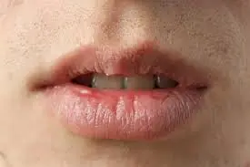 White Bumps on the Lips or Intimate Areas? Experts Explain the Possible Causes
