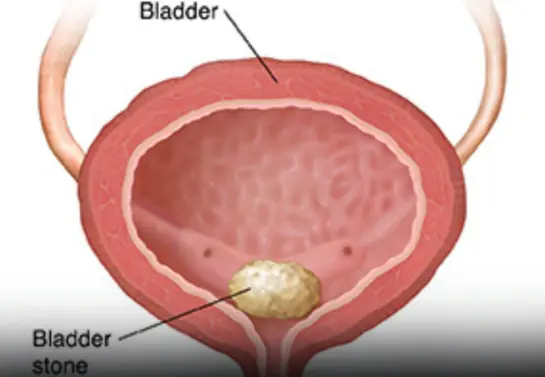 Is Your Body Sending a Signal? Early Signs of Bladder Can:cer