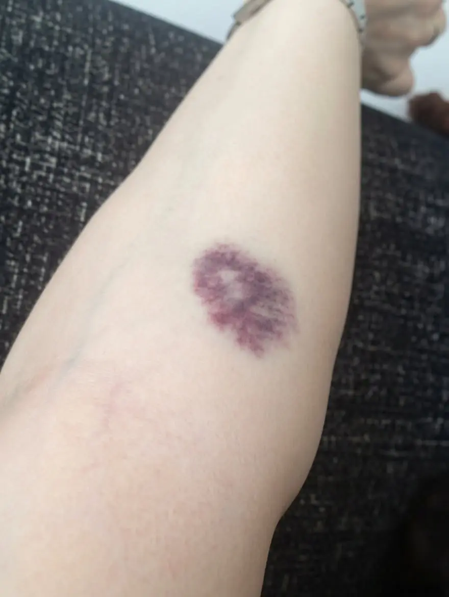 Unexplained Bruises: When Should You Be Concerned?