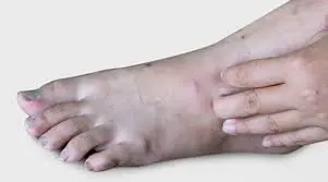 Know the 9 Warning Signs of Diabetes Before It's Too Late to Act