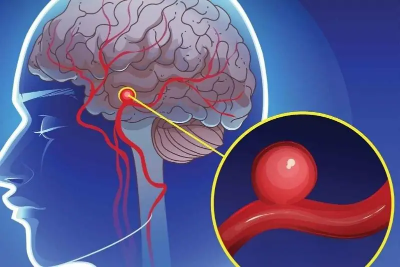 An Aneurysm Can Be Silent—Until It Isn't. Know the Warning Signs