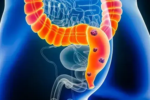 Your Digestive System May Show These 5 Warning Signs of Colon Can.cer