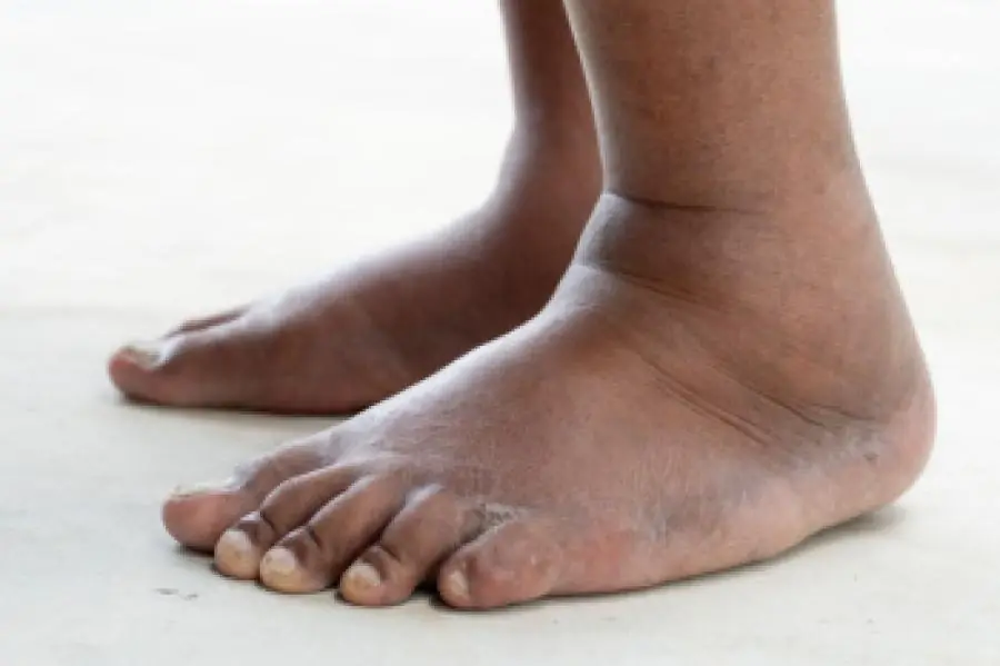 23 Weird Signs of Kid.ney Disease Most People Will Miss! Doctors Say These Symptoms Should Never Be Ignored