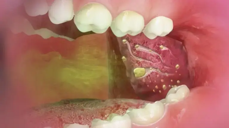 7-Year-Old Boy Bullied Over Bad Breath—Doctors Discovered the Hidden Cause Inside His Mouth