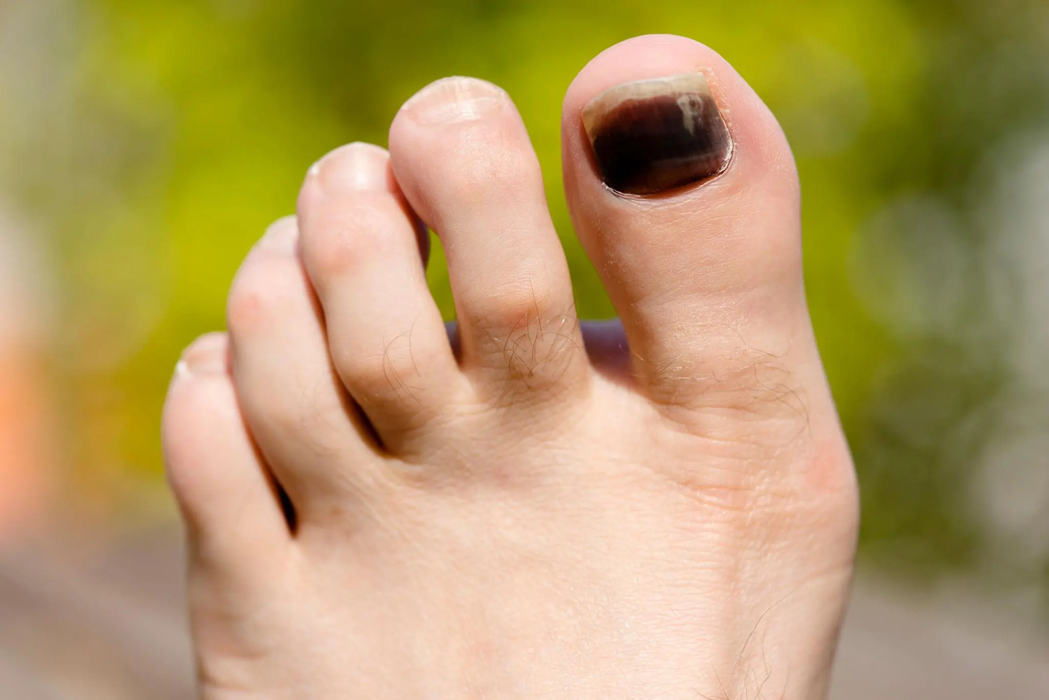 Black Toenail? Here's What It Means and What You Should Do
