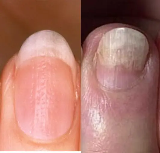 These 4 Symptoms in Your Hands and Feet Could Be Early Warning Signs of Can.cer