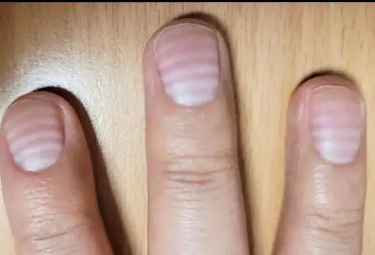 Your Fingernails Could Be Sending Silent Health Warnings—Especially After Age 40