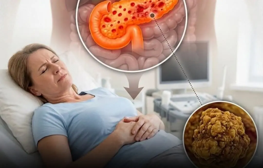 Pancreatic Cancer Is Often Called a Silent Disease — Watch for These Signs