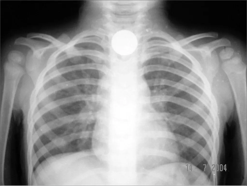 3-Year-Old Di.es After Swallowing a Coin While Playing: Doctors Urge Parents to Stay Alert to Choking Hazards