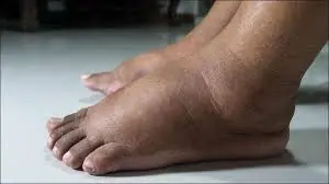Leg Swelling Isn't Always Harmless—These Possible Causes May Surprise You