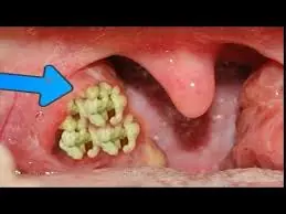 Those White Bumps in Your Mouth Aren't Always Harmless—Here's Why