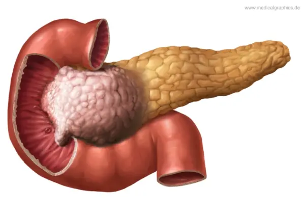 Your Body May Be Sending Warning Signs of Pancreatic Cancer—Here's What to Watch For