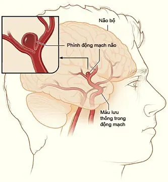 These Symptoms Could Signal an Aneurysm—Don't Ignore Them