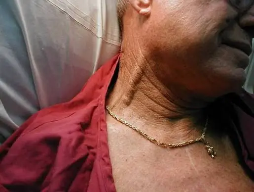 Notice Bulging Veins in Your Neck? Here's What You Should Know