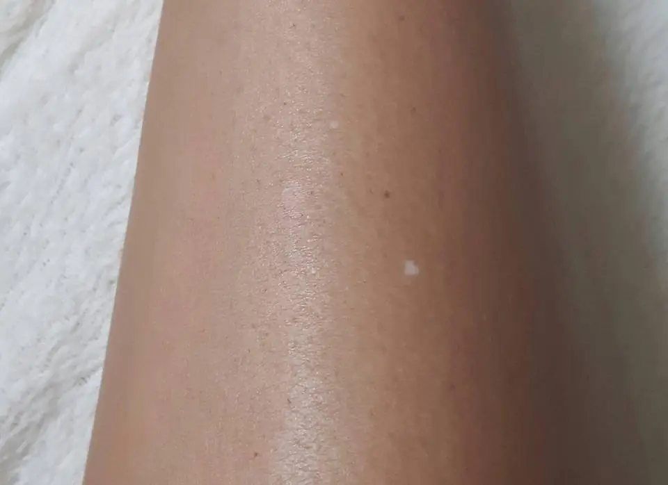 Tiny White Spots on Your Arms or Legs? Here’s What They Could Really Mean