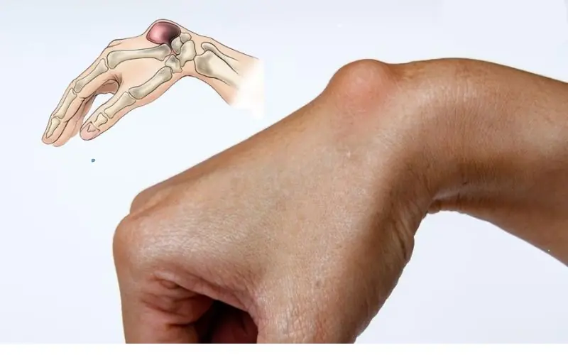 A Bump on Your Wrist? Doctors Say It's Worth Getting Checked