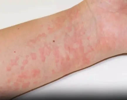Surprising Causes Of Hives Revealed — What May Be Triggering Your Skin Reaction