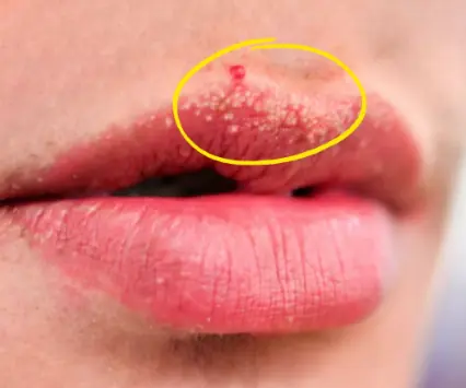 Why You Might See Unusual White Bumps On Your Lips Or Genitals