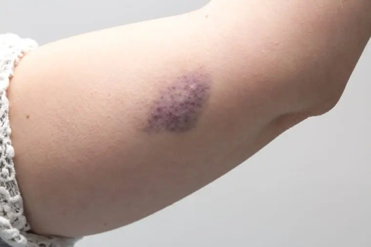 Frequent or Unexplained Bruising? Here's What You Should Know