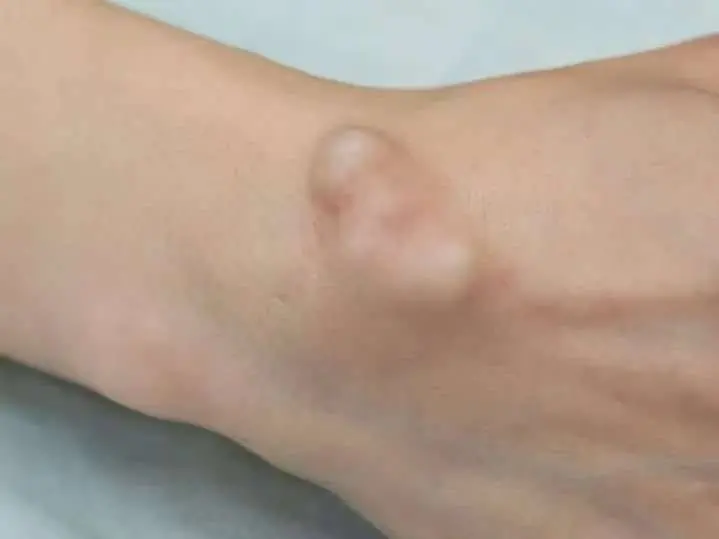 If You Notice These Lumps, They Could Be an Early Warning Sign of Can.cer—Doctors Urge You Not to Ignore Them