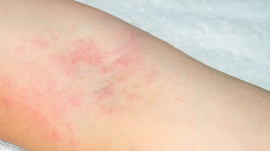 He Ignored What Looked Like an Allergy - Until Doctors Found the Real Cause