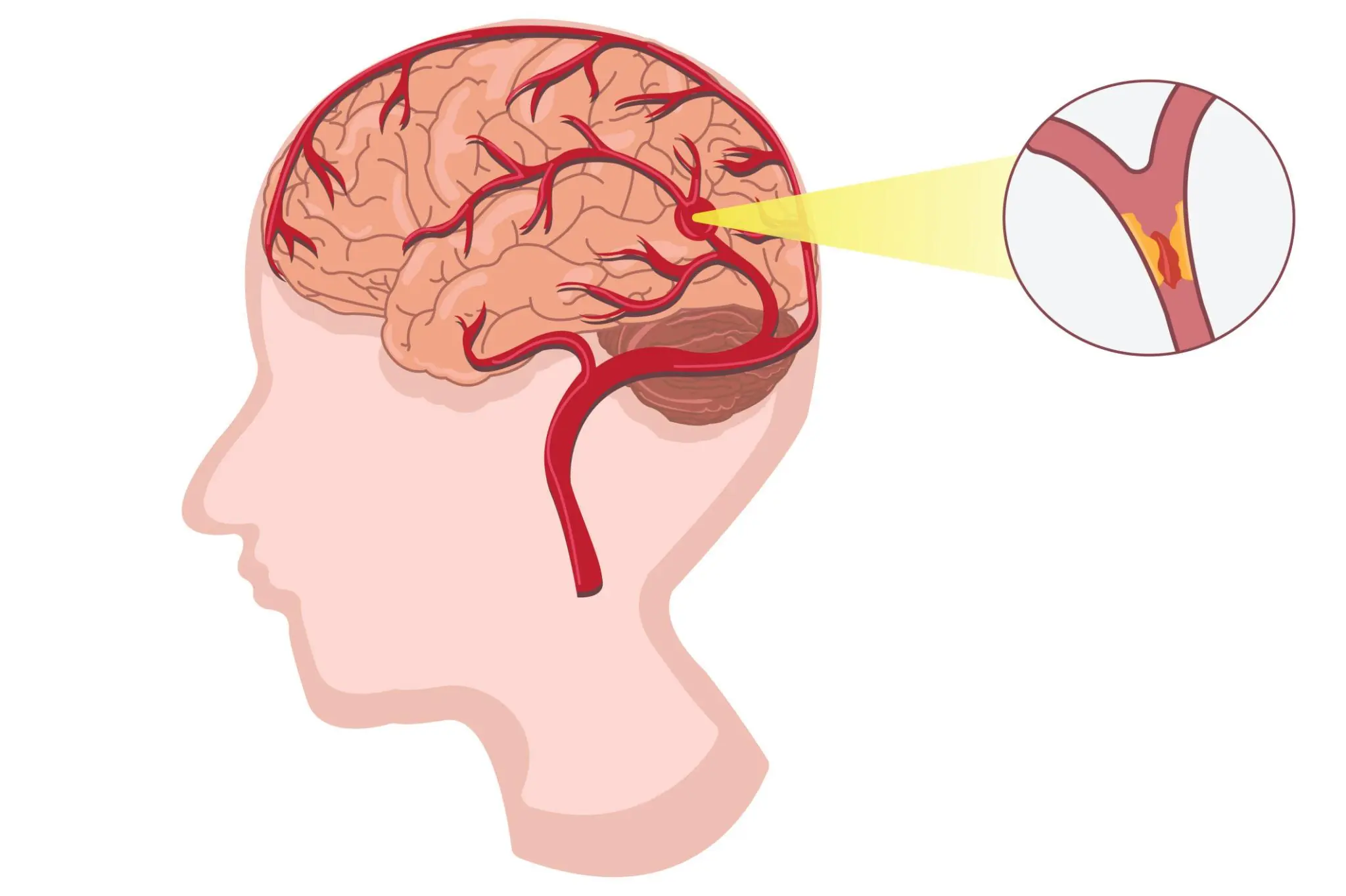 A Month Before a Stroke: 10 Warning Signs Your Body May Be Trying to Tell You Something