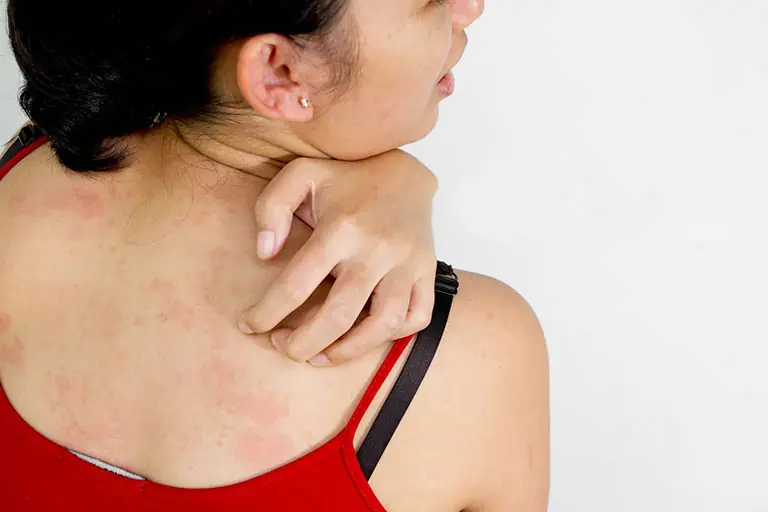Watch for These 4 Skin Changes That Could Indicate Liver Disease