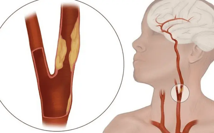 Blocked Arteries Can Be Silent—Learn the 10 Warning Signs