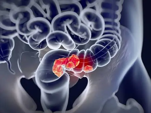 5 Symptoms That Could Be Warning Signs of Colon Cancer—Don't Ignore Them