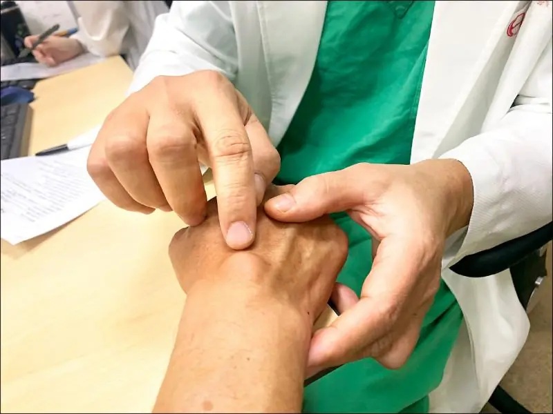 Unusual Lump on the Wrist? Don’t Ignore It — It Could Be a Warning Sign of a Ganglion Cyst