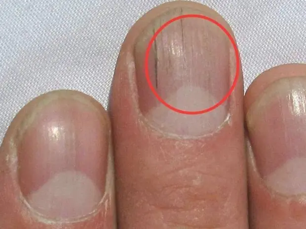 These Nail Changes After 40 Could Mean More Than Normal Aging