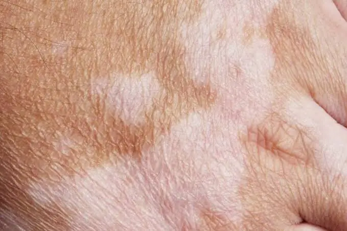 Noticing Small White Spots on Your Skin? Here's What a Specialist Wants You to Know
