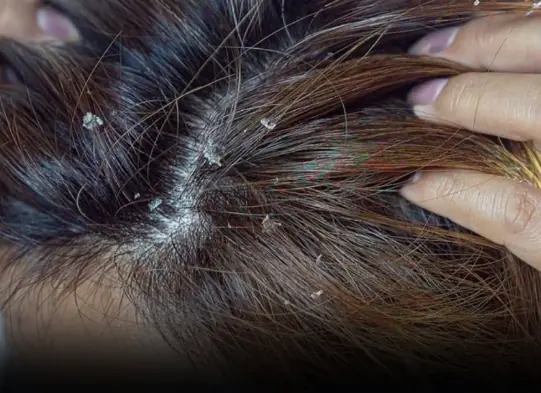 One dangerous can.cer warning sign is often mistaken for dandruff — please don’t ignore it any longer