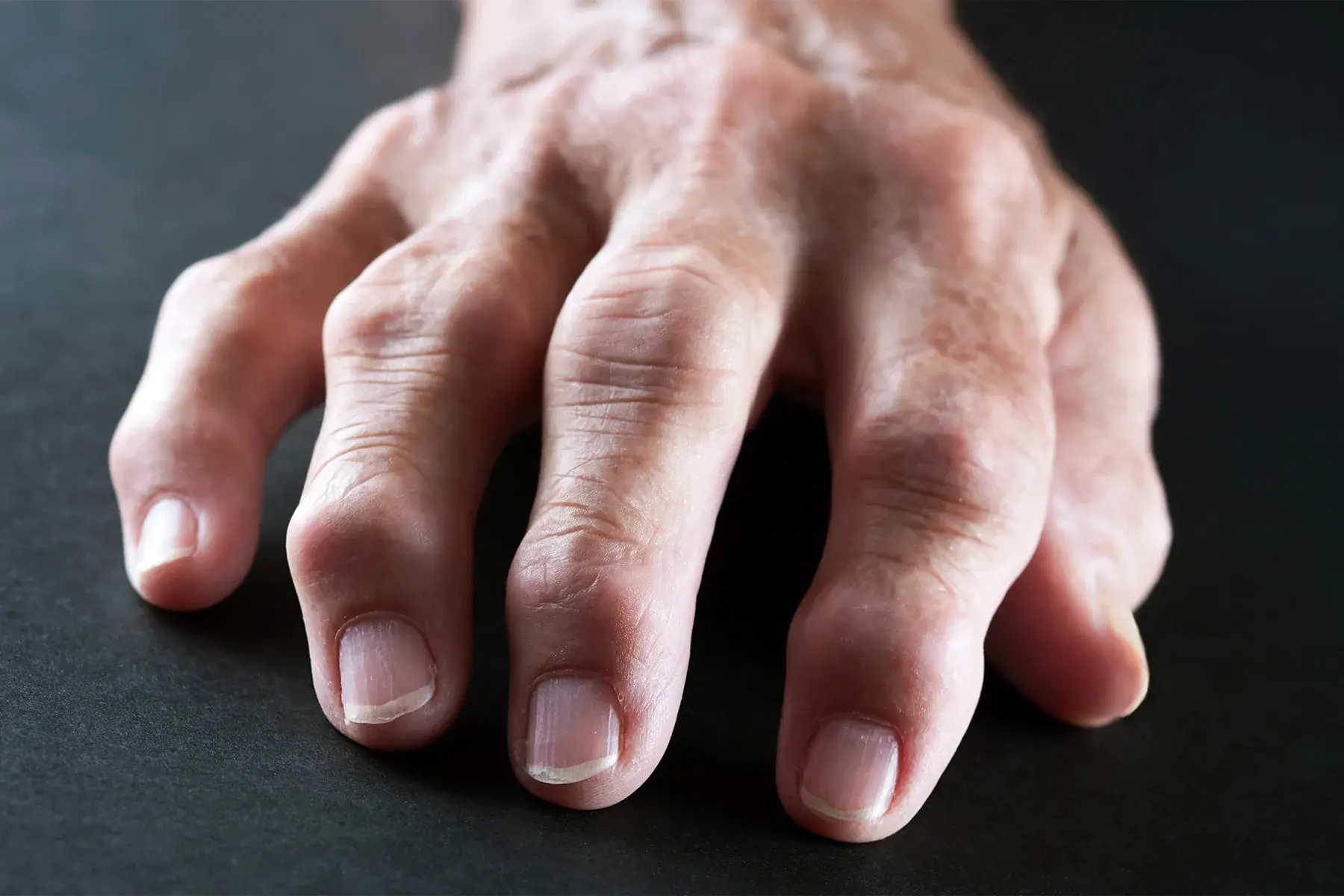 Could Your Joint Pain Be Arthritis? Here Are 7 Signs to Watch For
