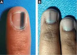 Your Fingernails May Be Sending Health Signals—Don't Miss These Changes