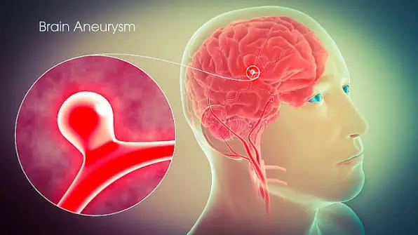 What Are the Signs of an Aneurysm? Here's What to Watch For
