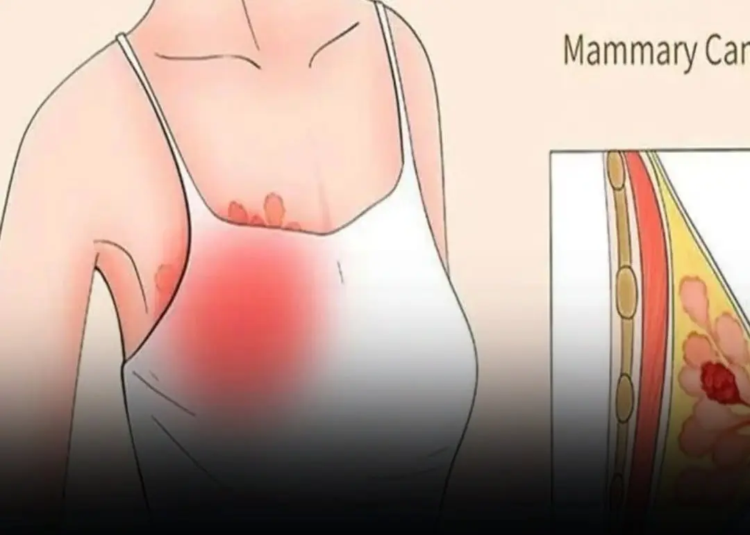 Early Bre:ast Can:cer Symptoms That Often Go Unnoticed — What Doctors Want You to Know