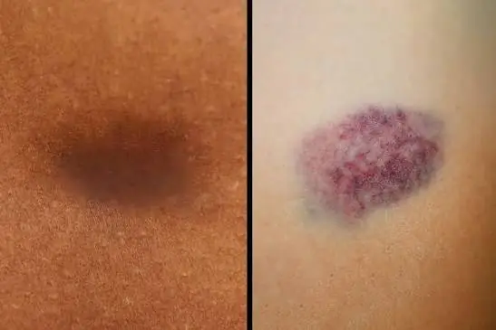 Strange Bruises That Appear Out of Nowhere? Here's What Doctors Want You to Know... See more