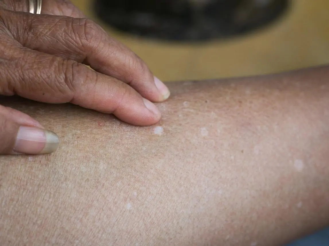 Tiny White Spots on Your Arms or Legs? Here's What They Could Mean