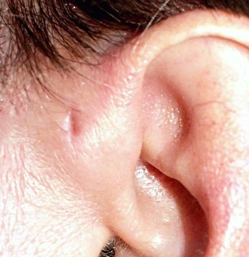 The Tiny Hole Near Your Ear: A Rare Trait That May Reveal an Ancient Evolutionary Secret