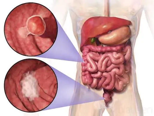 Doctors Say Younger Adults Shouldn't Ignore This Possible Colon Cancer Warning Sign...