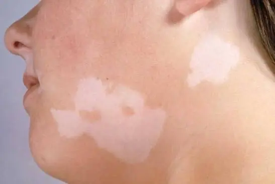 Wondering About Those Tiny White Spots on Your Skin? Here's What Experts Say