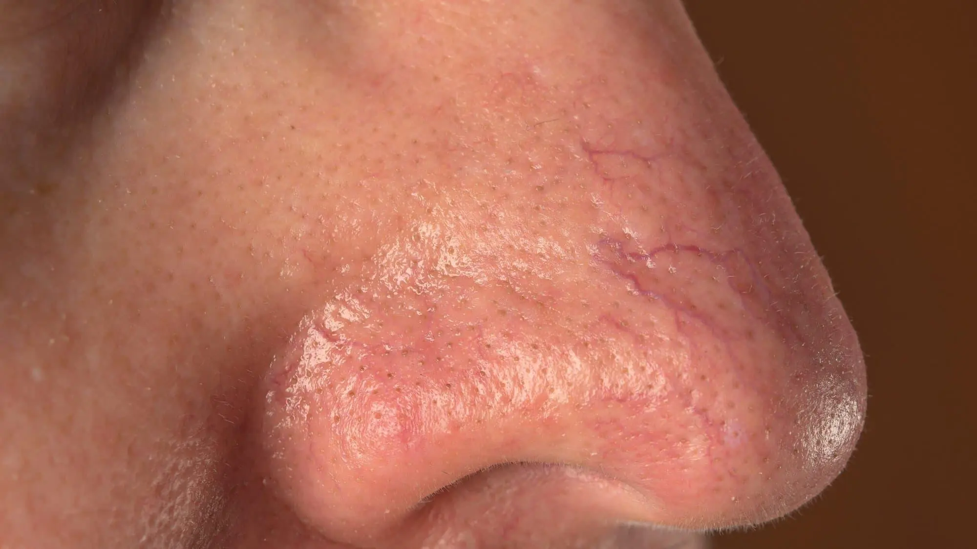 5 Warning Signs on Your Nose That Could Signal Serious Health Problems